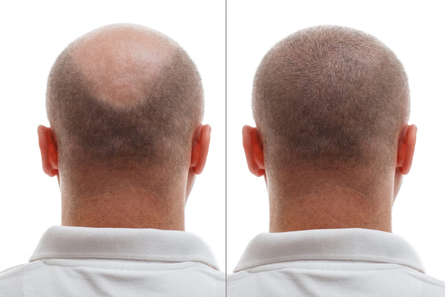 Hair Shedding After Hair Transplant Dr Levent Acar