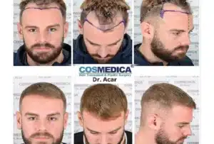 Haartransplantation-Türkei-vorher-nachher