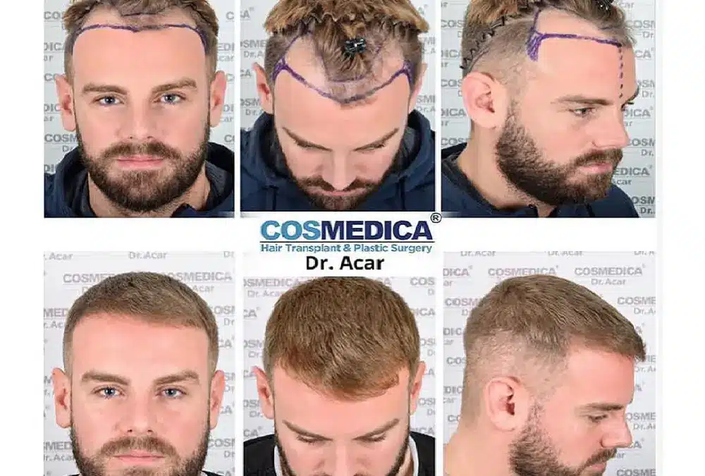 Haartransplantation-Türkei-vorher-nachher