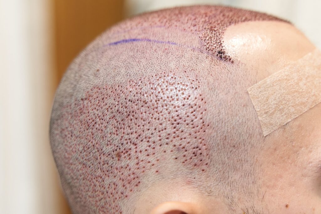 Side view of male scalp after hair transplant surgery.