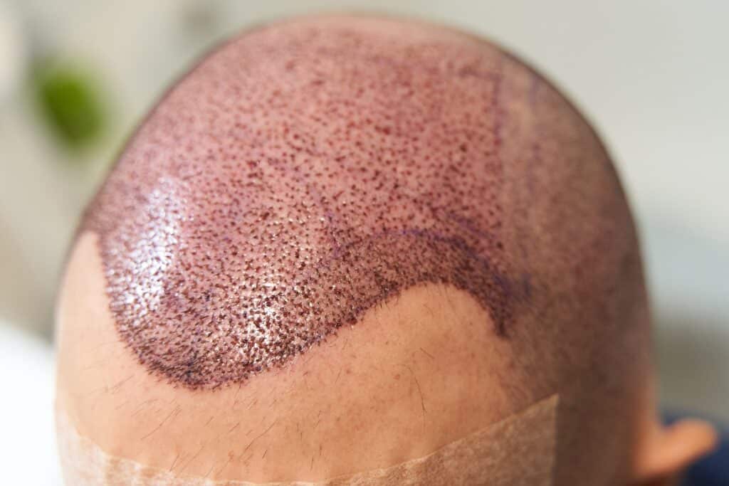 Detail of hair line with redness after hair transplant surgery to cure baldness