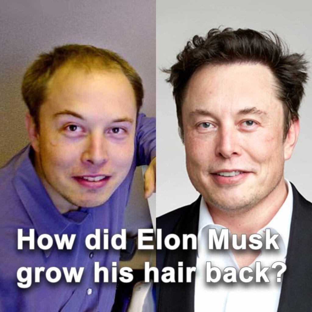 how did elon musk grow his hair back