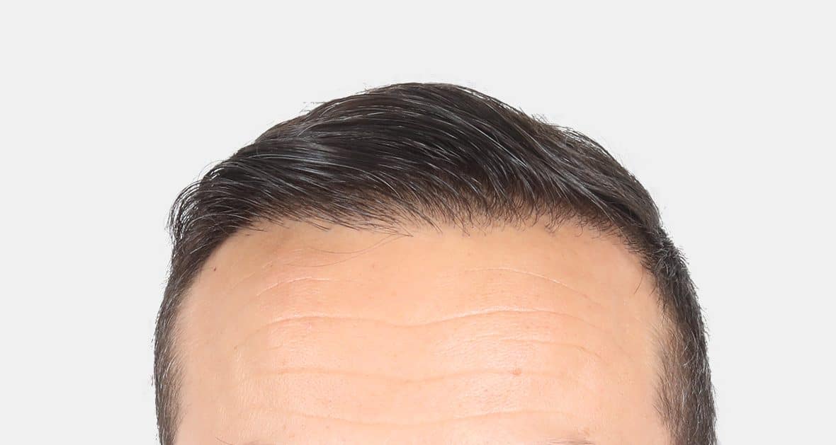 after results hair transplant 4500 grafts hairline