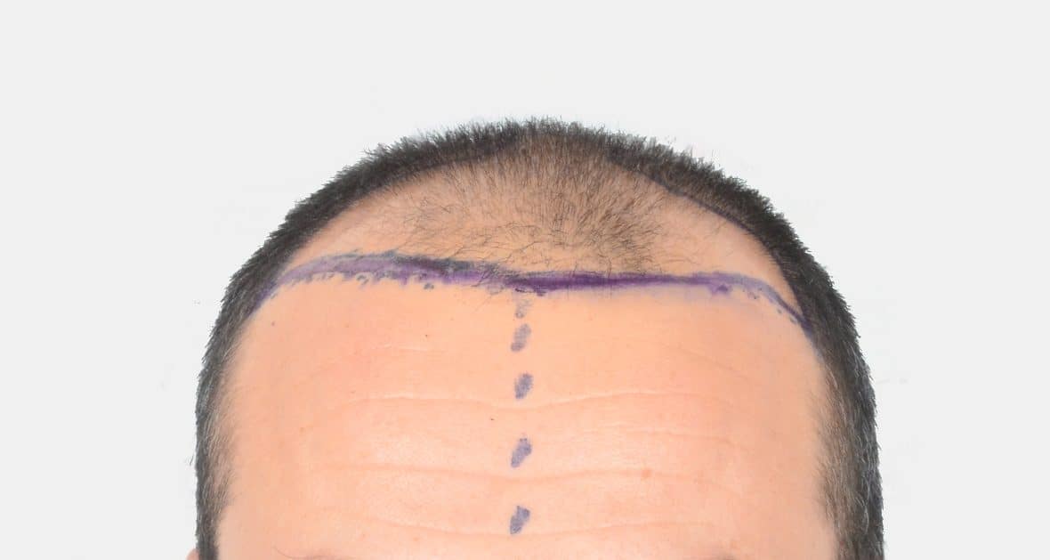 before results hair transplant 4500 grafts hairline