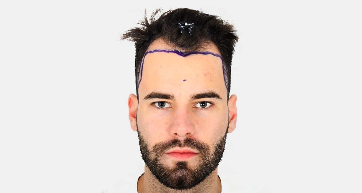 before results hair transplant 4760 grafts