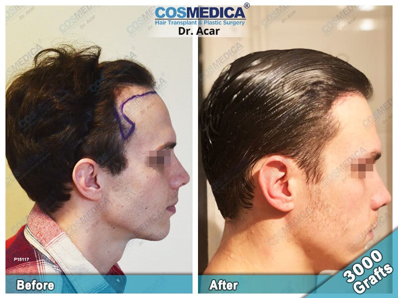Hair Transplant Cost USA 2020 | The Best Clinics