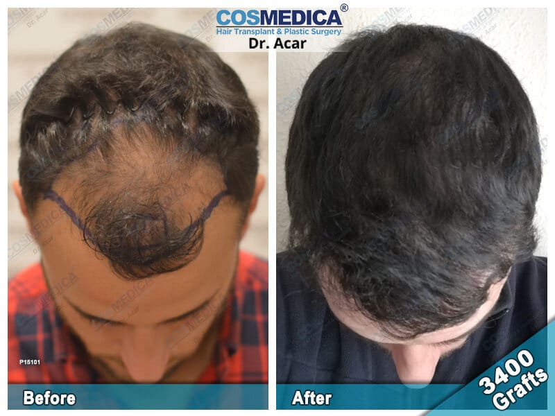 Hair transplant Turkey Before After – Cosmedica | Dr. Acar