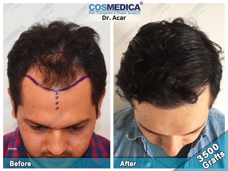 Hair transplant Turkey Before After – Cosmedica | Dr. Acar