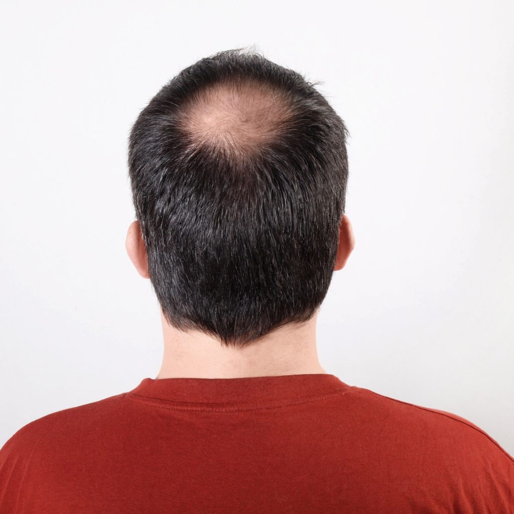 The reasons for hair loss - Cosmedica