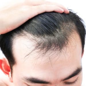 Stressed man with thinning hair