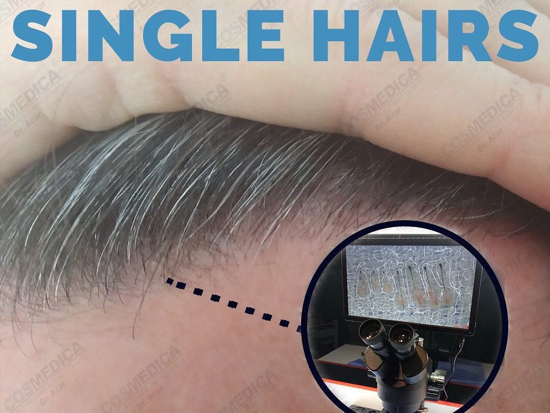 natural hair line with single grafts in the front hair transplant
