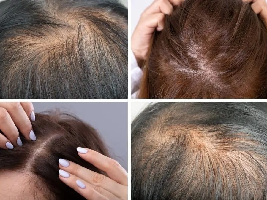 Ask the Plastic Surgeon Thinning hair in women