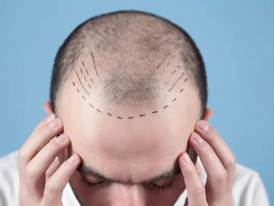Hair Transplant Pain - Cosmedica Clinic | Dr. Levent Acar