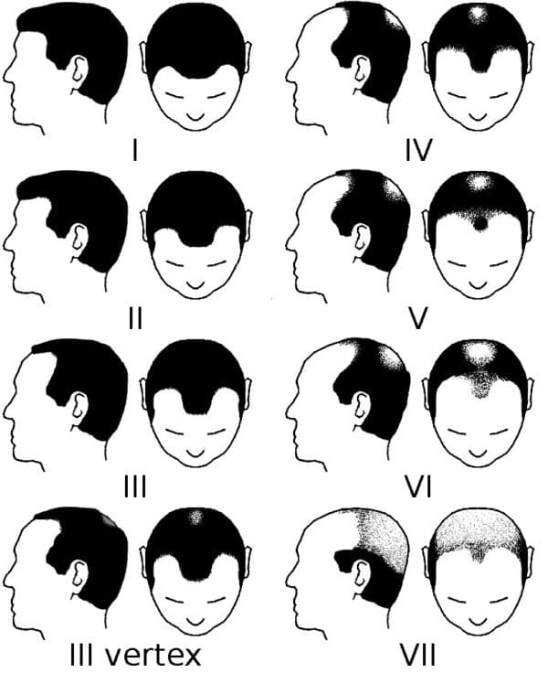 Calvitie vertex Quelles solutions ? Cosmedica