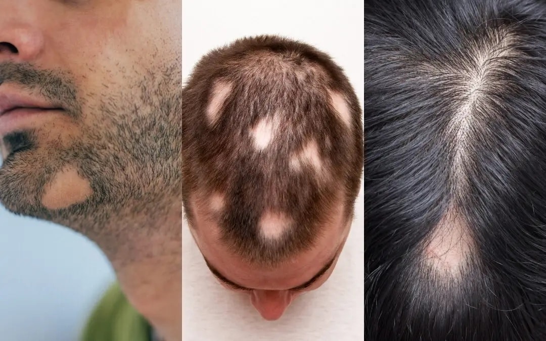 Circular or patchy hair loss – Alopecia Areata | Dr. Acar