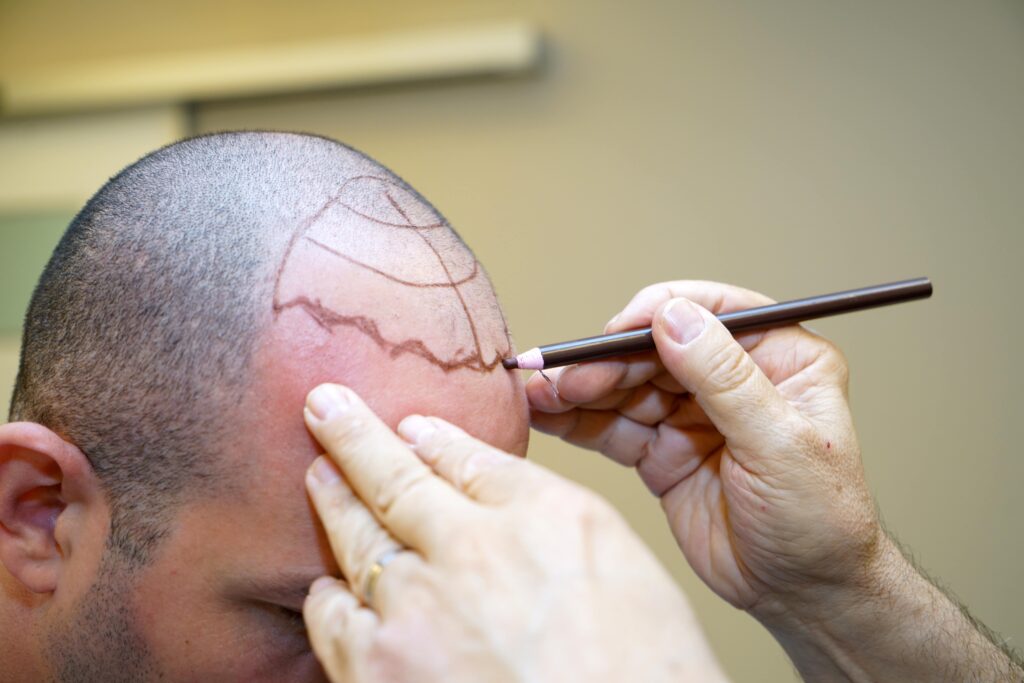 Patient suffering from hair loss in consultation with a doctor.