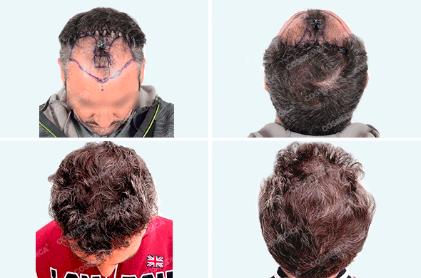 Мужчина с пересаженными волосами фото до и после