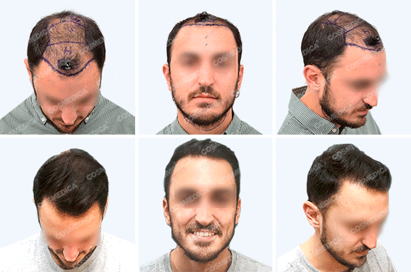 Пациент фото до и после пересадки волос