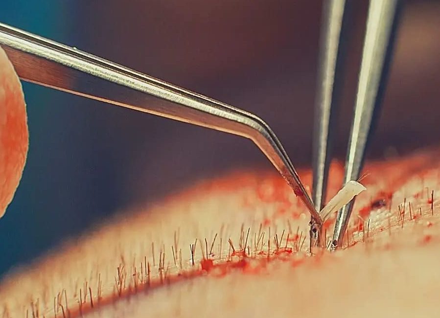 how many hair grafts