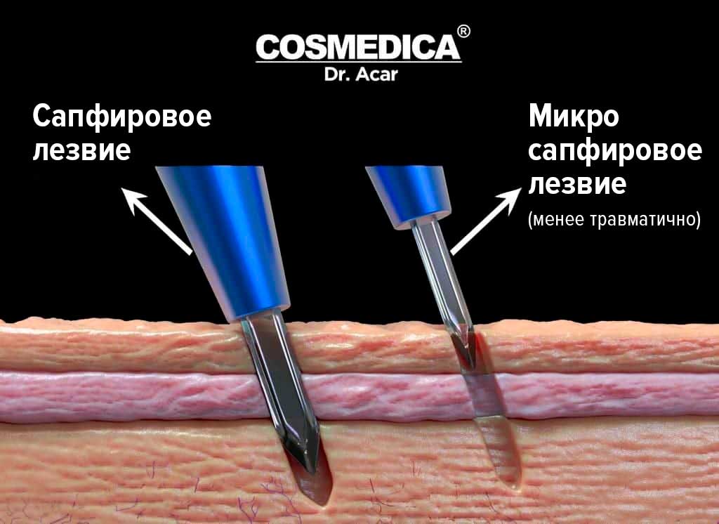 Пересадка-волос-в-Турции-сапфировое-лезвие-Micro-Saphir