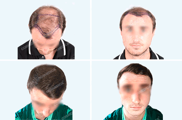 Пациент фото до и после пересадки волос