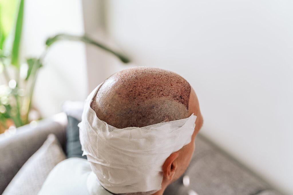 Homme portant un bandage après une greffe de cheveux.
