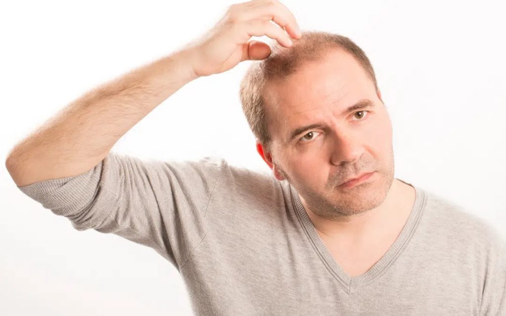 hair transplant another person's hair