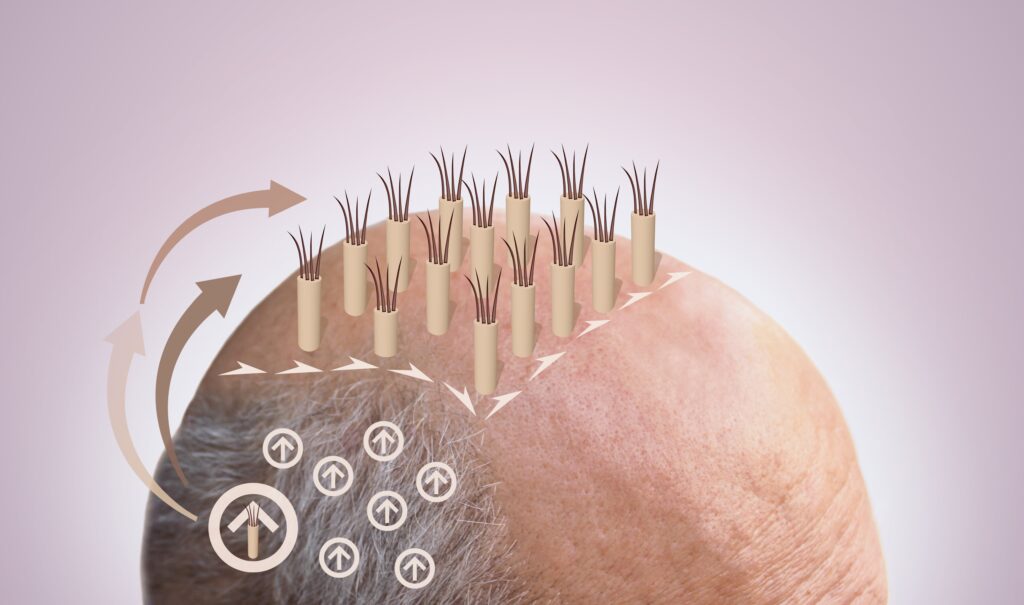 FUE hair transplant process