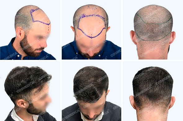 Голова после пересадки волос. Пересадка волос в Турции. Кепка для головы после пересадки волос. Повторная пересадка