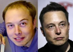 Илон Маск до и после пересадки волос