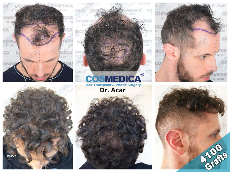 Trasplante capilar sin cortar el pelo - Precio en 2024 - Heva Clinic Turquía