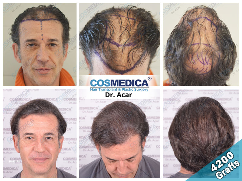 Hair Transplant in Turkey Result with 4200 Grafts