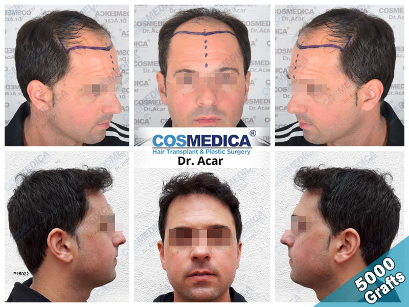 hair transplant turkey before after 5000 grafts
