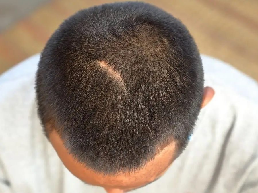 Przeszczep włosów: wszystko o bliznach po zabiegu