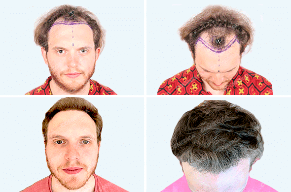 Мужчина с вьющимися волосами до и после пересадки волос