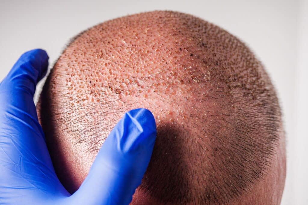 Photo d'un médecin examinant les croutes d'un patient après une greffe de cheveux