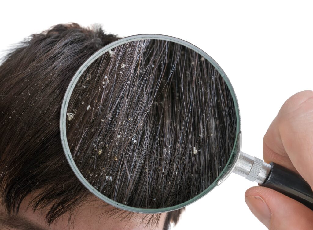 Examen à la loupe de pellicules dans les cheveux