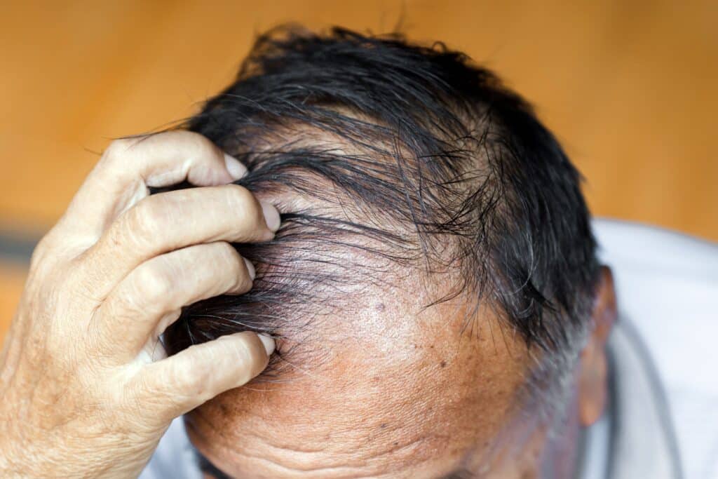 Homme âgé souffrant de perte de cheveux et de cheveux gras