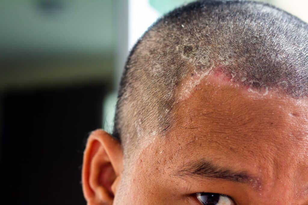 Scalp fungus is a condition that can cause the skin on the scalp to flake