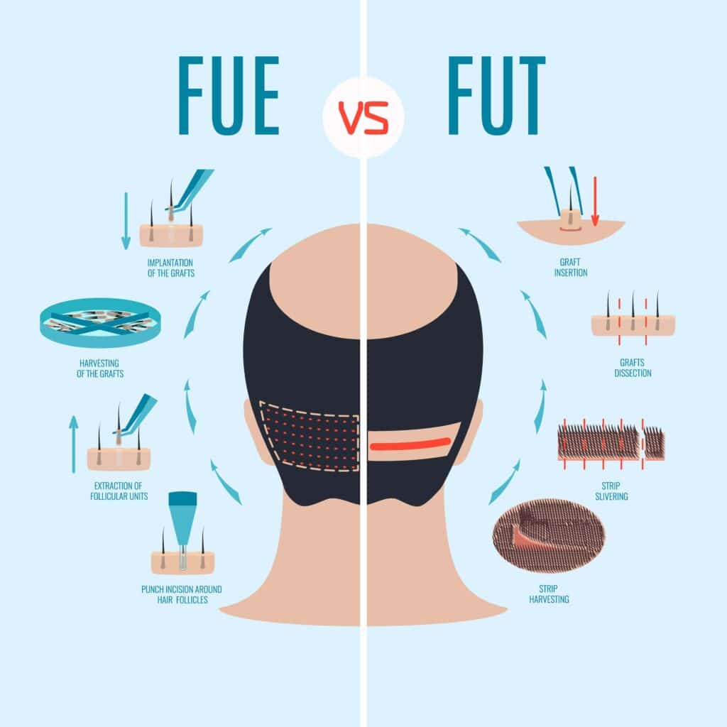 Contrairement à la Turquie, de nombreuses cliniques de greffe de cheveux en France continuent de proposer la méthode FUT