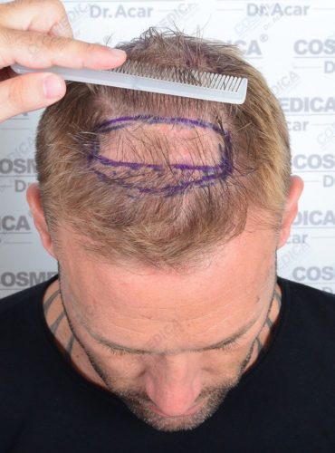 Dr. Acar combing back Calum Best's hair to show the extent of his hair loss on the top of his head