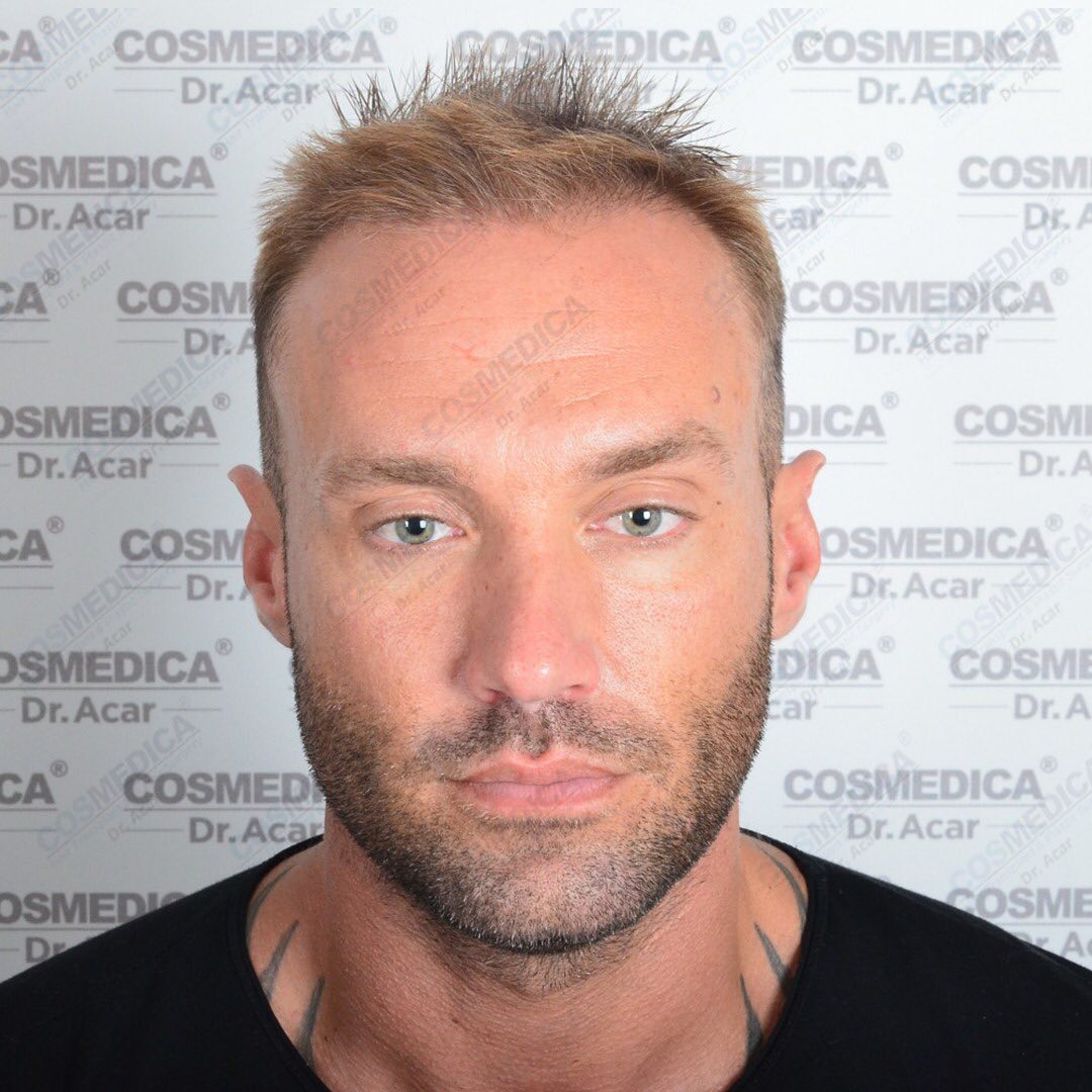 Calum Best frontal shot before the operation