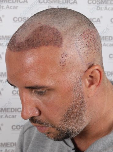 Keiran Lee hair transplant directly after operation