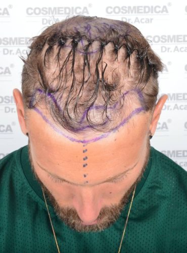 Liam McAleese shot of the top of his head where you can see the extent of his hair loss