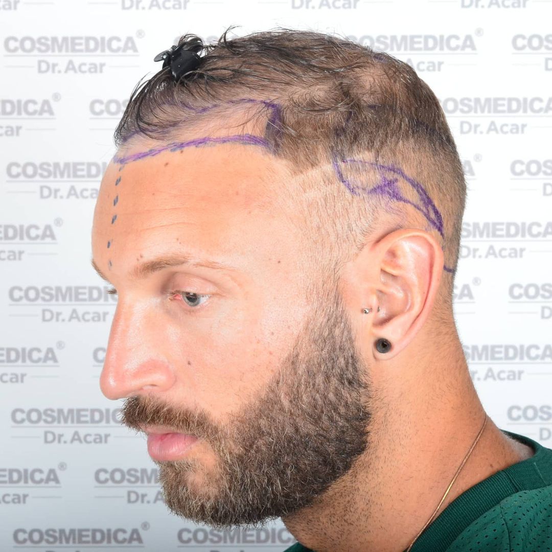 Liam McAleese shot of the left side of his head, showing the markings on his forehead and the extent on his hair loss