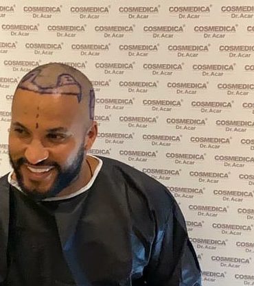 Ricky Whittle in surgery gown with markings on his head ready for the transplant