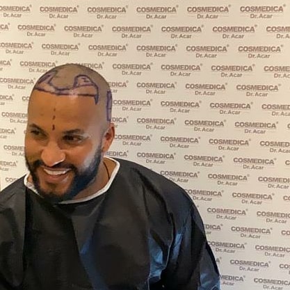 Ricky Whittle in surgery gown with markings on his head ready for the transplant