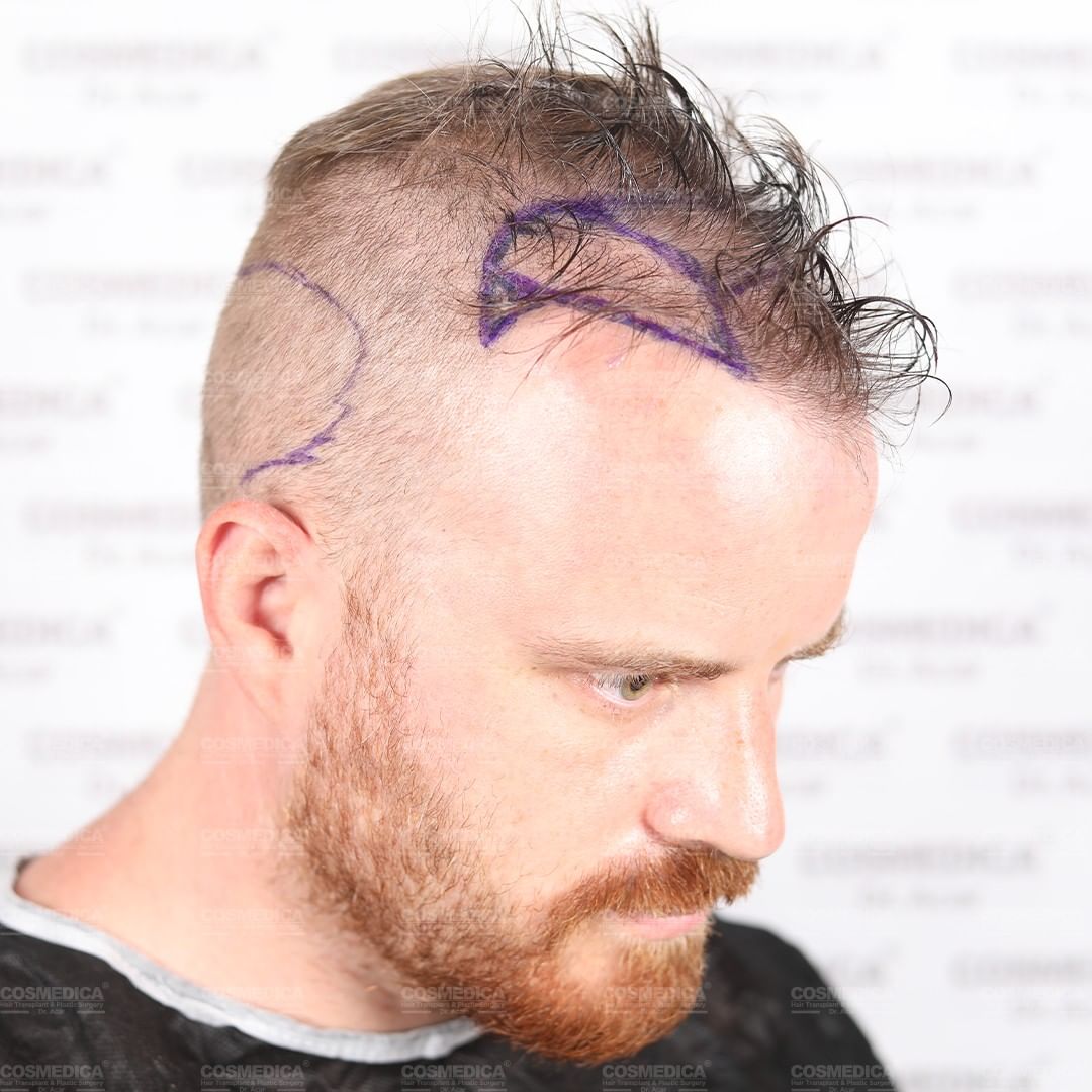 Rob Kazinsky's right side showing off the markings and extent of his hair loss