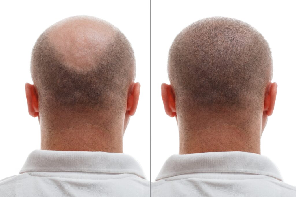 The head of a balding man before and after hair transplant surgery