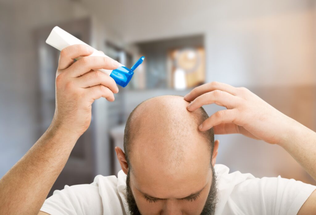 Man getting post operative care after a hair transplant